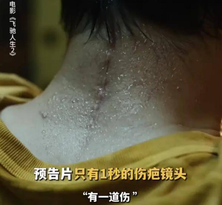 沈腾颈椎手术高清疤痕照曝光,颈后开刀延至背部,后遗症难改变