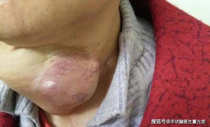 甲状腺癌照片图片