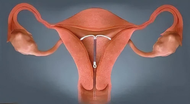 若取环时间过早,还有怀孕的可能;而取环过晚,则可能带来健康隐患.