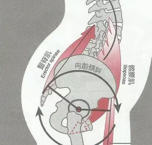 髂腰肌综合征图片