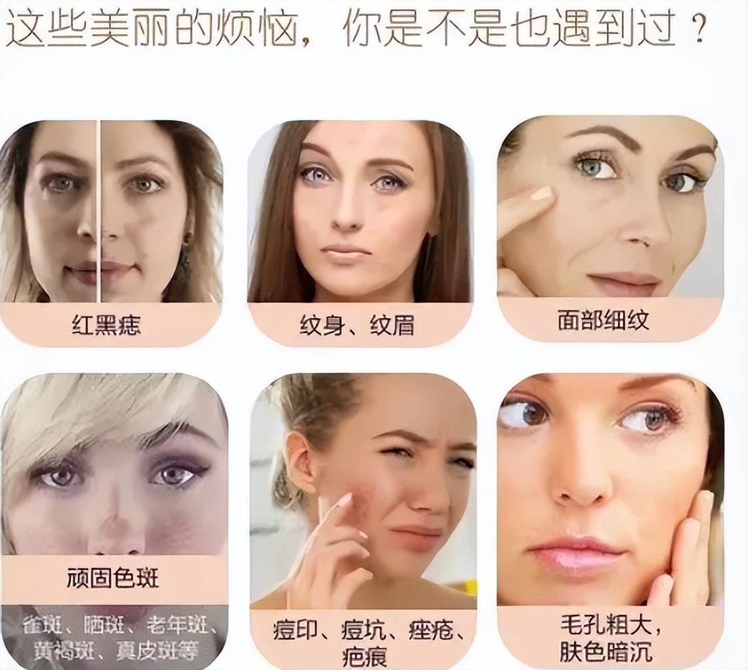 盘点一波:超皮秒激光祛斑的危害与效果,超皮秒祛斑的副作用?