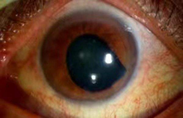 杀年牛反遭牛踢 男子左眼被踢伤险失明_刘师傅_视力