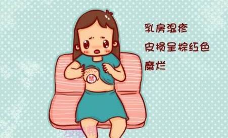 哺乳期妈妈患上乳房湿疹怎么办?