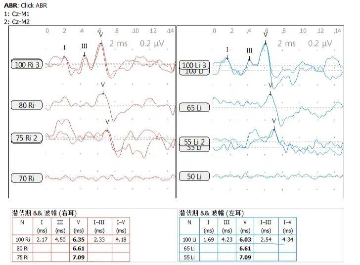 听力检查报告正常图片图片