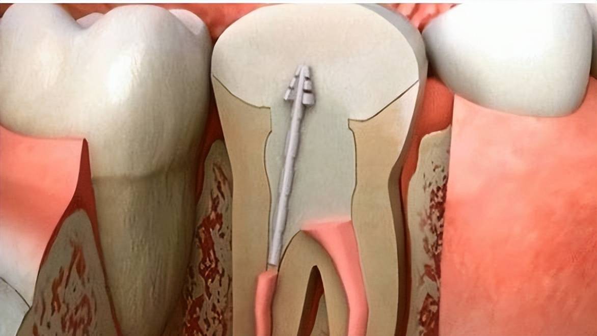 乳牙根管治疗图片图片