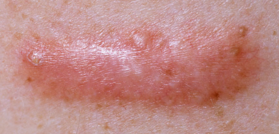 蔡忠廷医学博士 : 疤痕形成,再生机制及种类_皮肤_表皮_scar