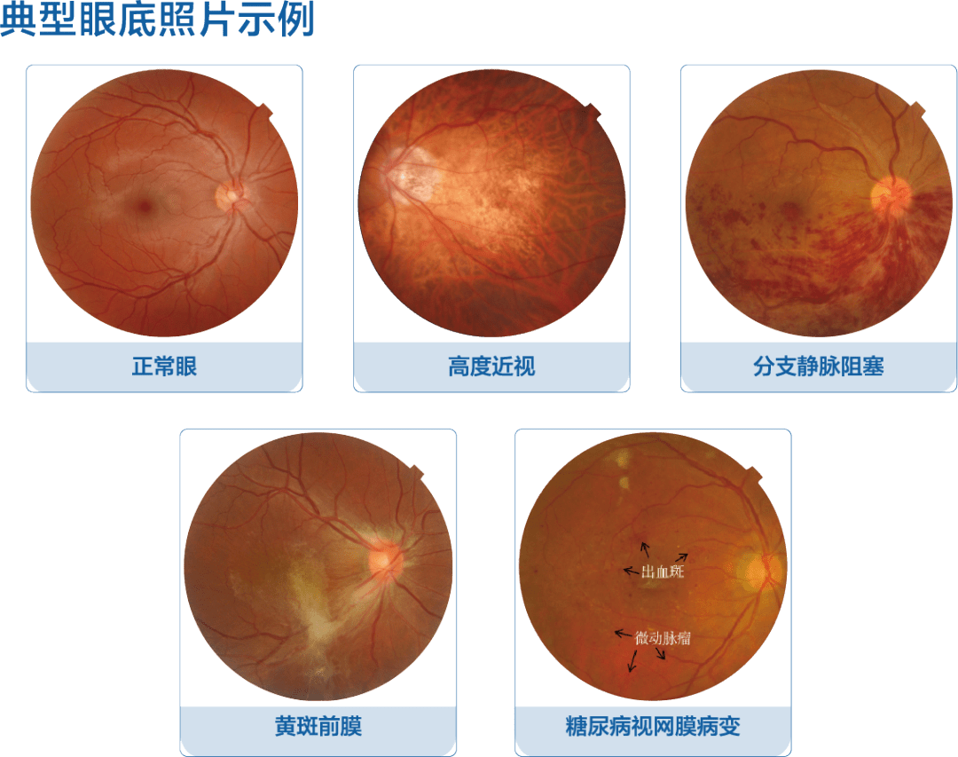 上海眼科院长科普:做完白内障手术后,视力会恢复的更好吗?