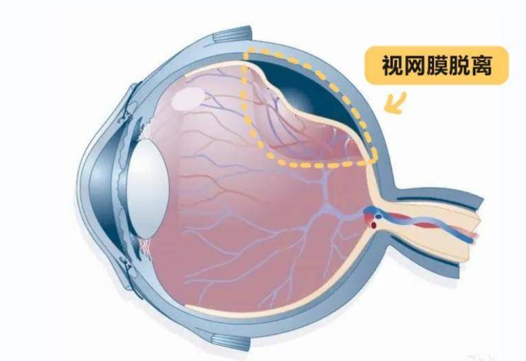 注意了!这4种情况易造成视网膜"分家",早知道早防范_陈娟_患者_眼球