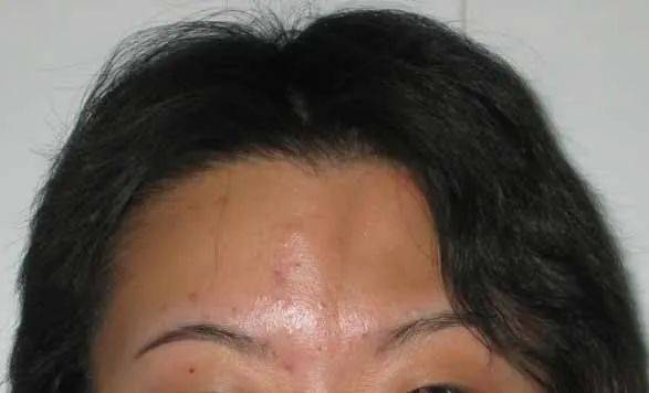 如果没有及时治疗,可能会导致患儿的皮肤色素沉着与头项,额头等部位