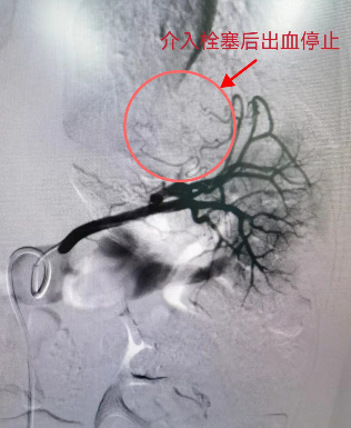 9岁娃车祸骨折脾脏破裂 西安市红会医院多科室协作介入救治_患者_诊疗