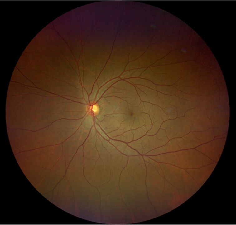眼前黑影飘动是飞蚊症?湖北普瑞专家提醒:当心视网膜裂孔在作祟_阿姨_