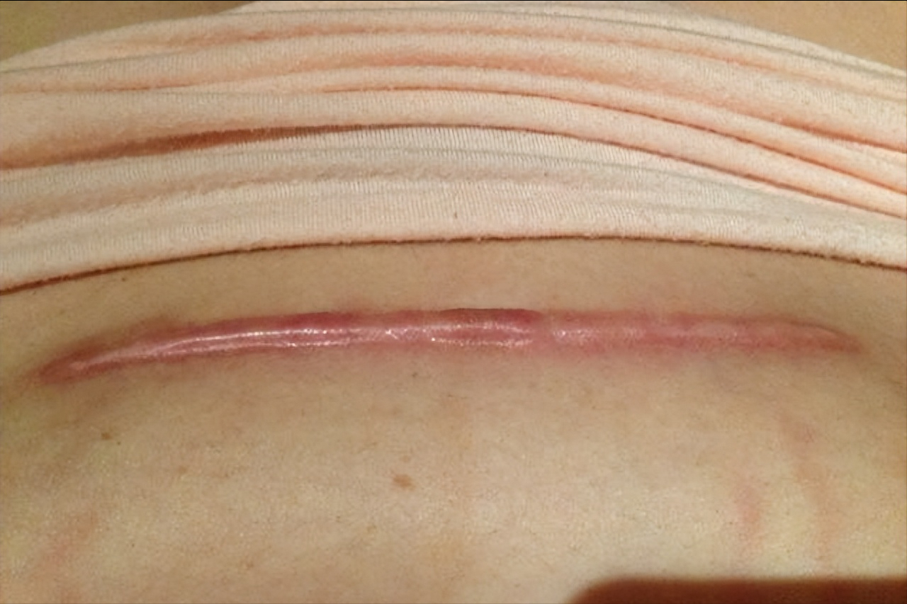 剖腹产刀疤正常图片图片