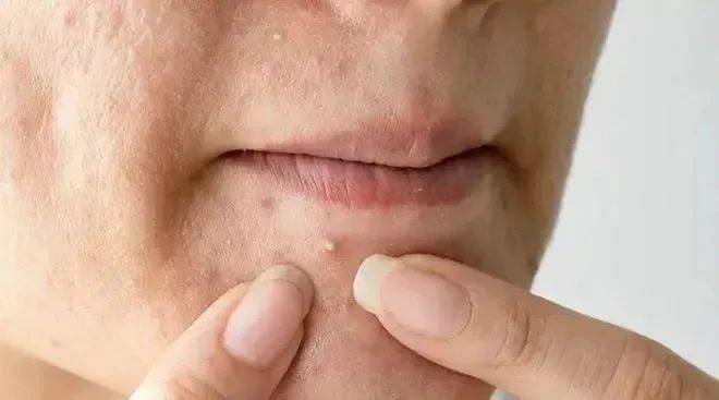 其成因多种多样,包括激素水平的变化,皮肤油脂分泌过多,细菌感染等.