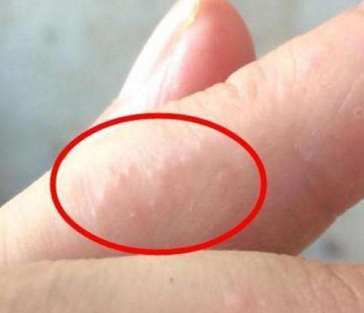 大多是由于真菌感染所引起的,在医学上叫做汗疱疹,它也属于皮肤湿疹的