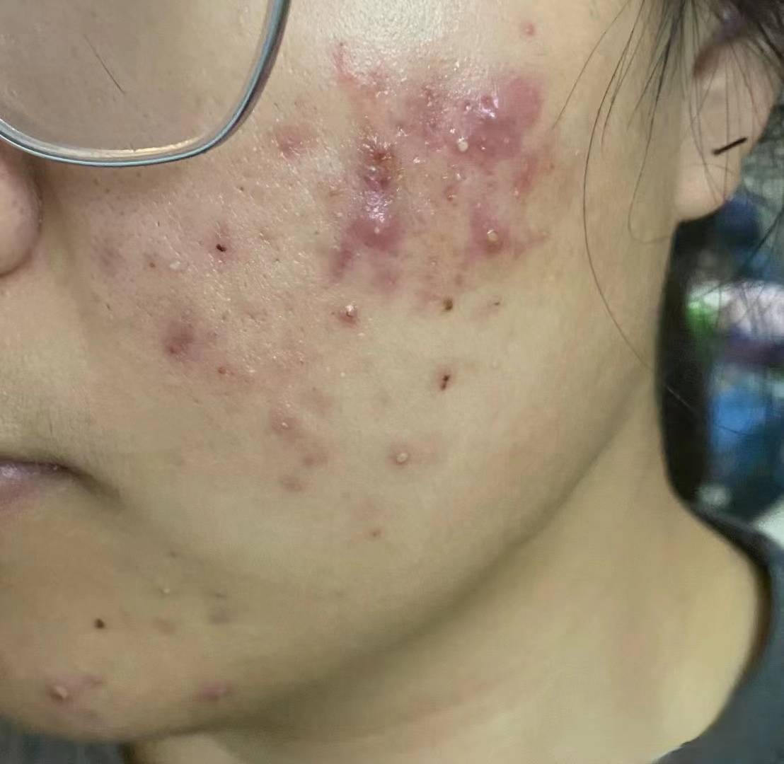 【如何治疗痤疮】我祛痘产品用了十几种,只有这个佰可颂凝胶温和的