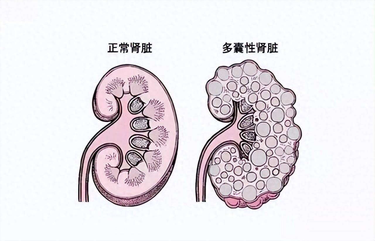 如何治疗多囊肾病?日常做好7个管理