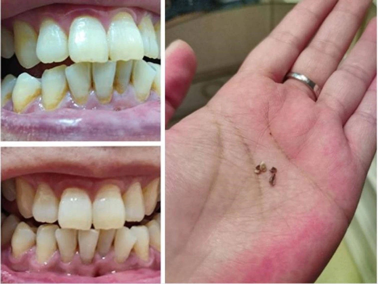 长了牙石抠不掉怎么办?过来人支你一招,牙结石哗哗自动往下掉!