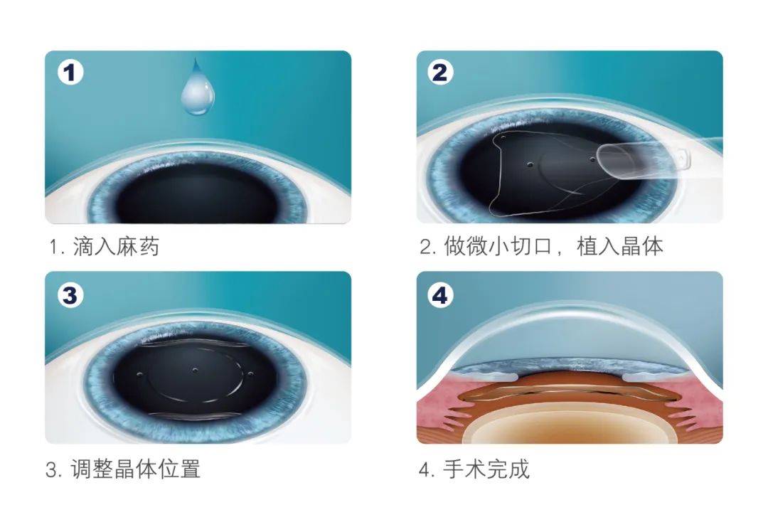 角膜_激光_晶体