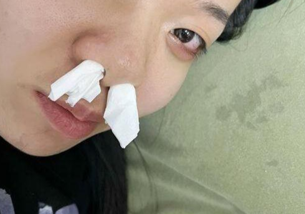 导致鼻腔黏膜充血,水肿等,从而引发或加重过敏性鼻炎