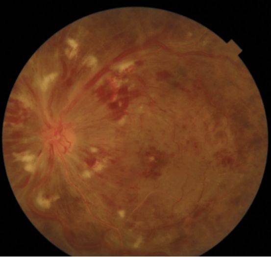 不可大意|容易致盲的五种眼底疾病_视网膜_黄斑_治疗