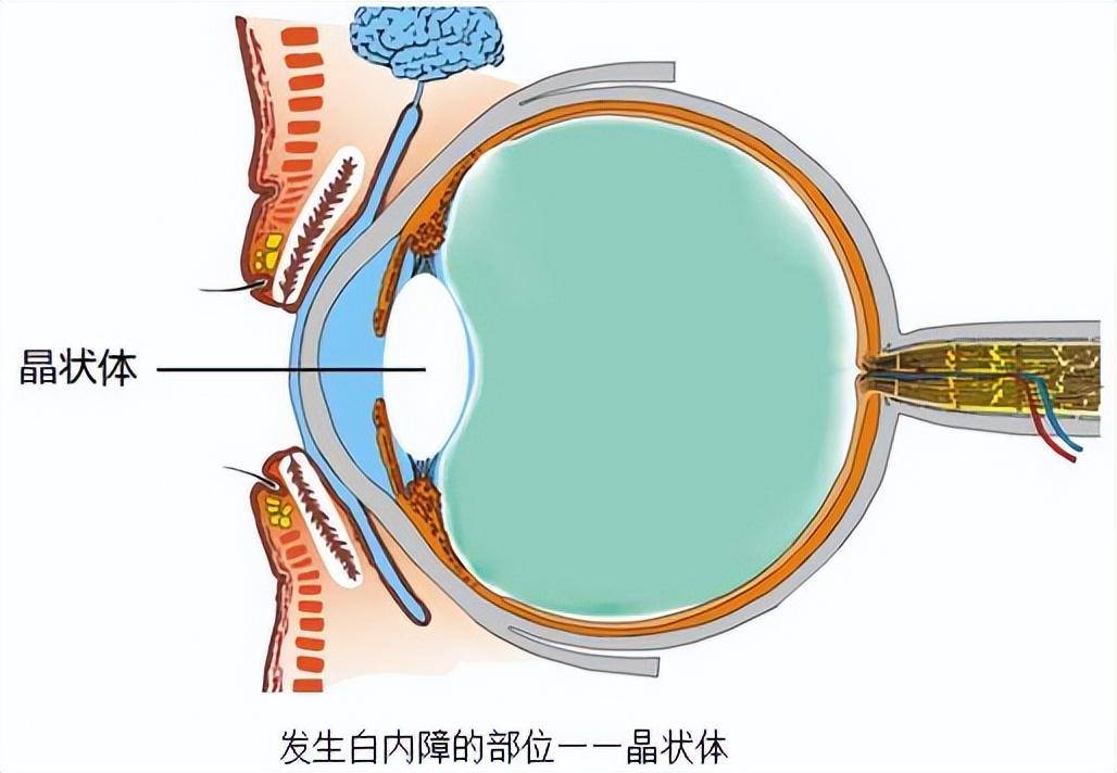 白内障手术后多久恢复图片