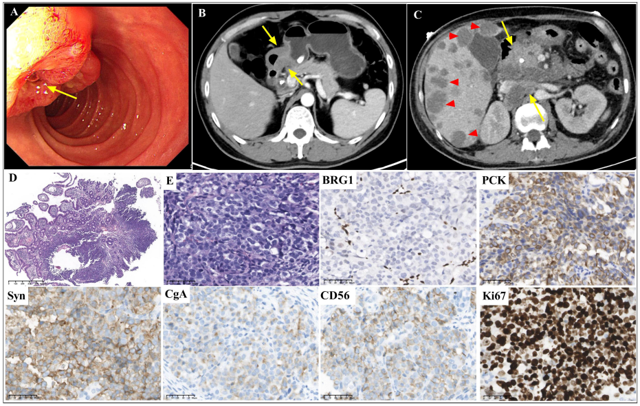 谈谈smarca4缺陷型胃肠神经内分泌癌的临床特征_肿瘤_细胞