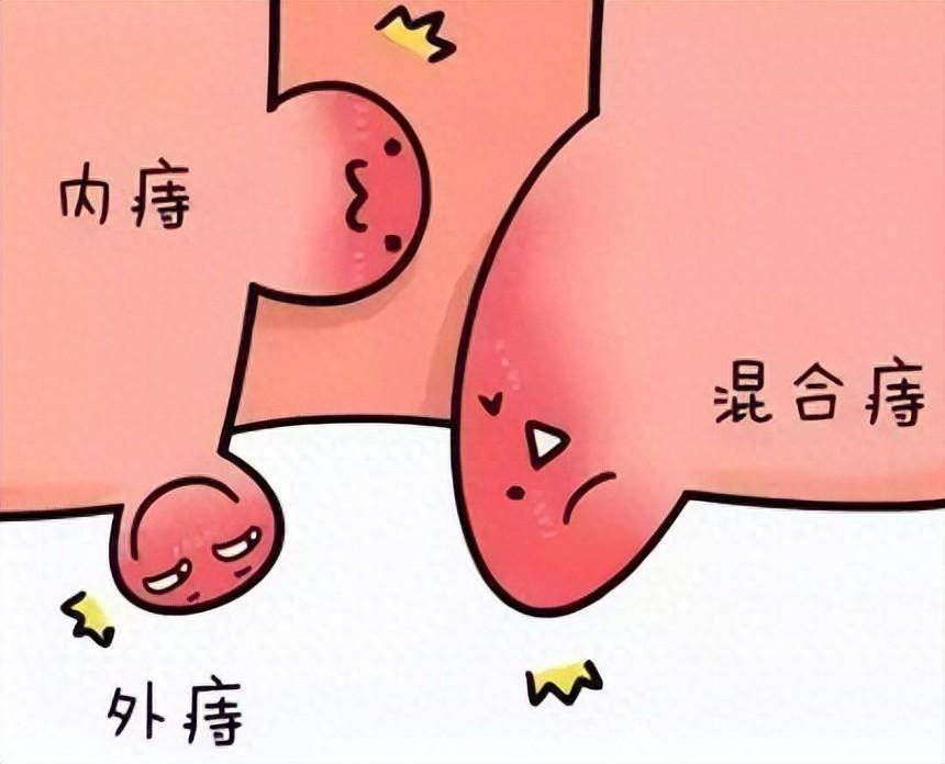 痔疮知多少?饮食运动双管齐下!告别痔疾困扰!