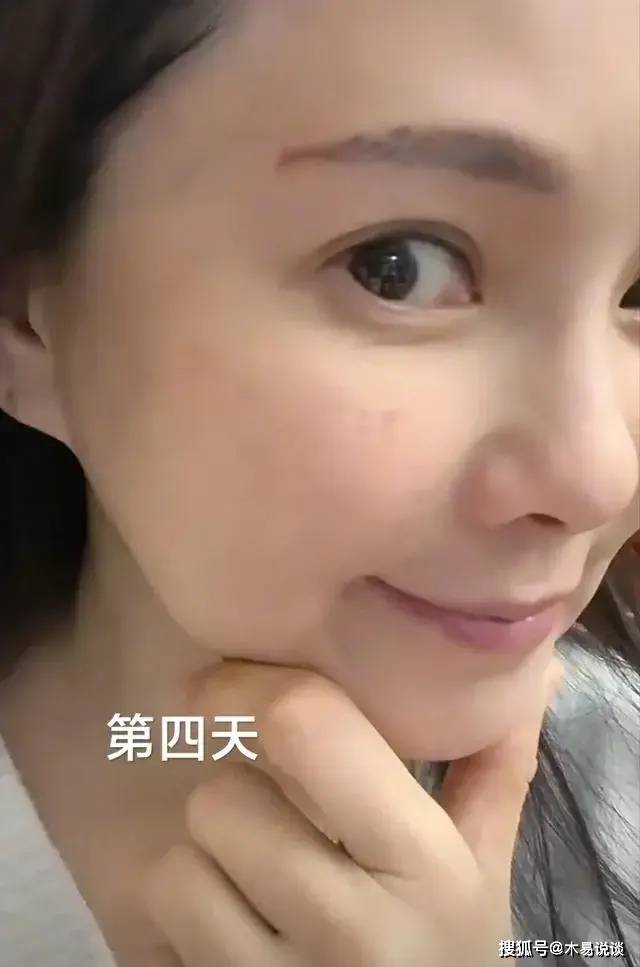 刚刚打完针的第二天,她的脸看起来针孔特别明显,用针扎脸,想想当时都