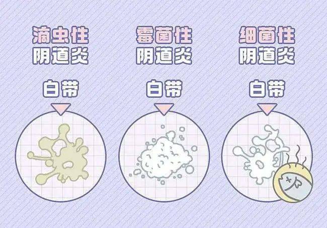 并且有腥臭味,这种情况常见于细菌性阴道炎,如果瘙痒比较明显,那可能