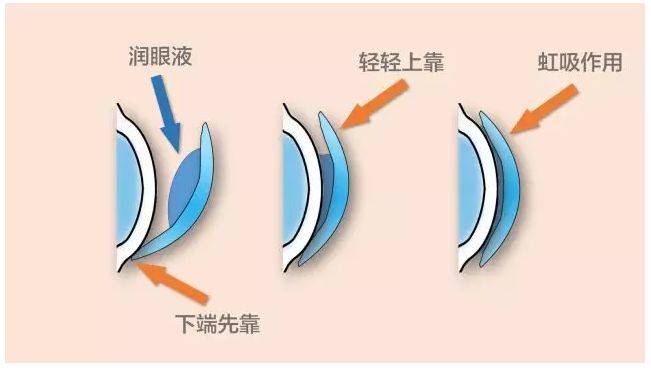 新手戴角膜塑形镜问题多?武汉普瑞眼科医院这篇干货请收下!