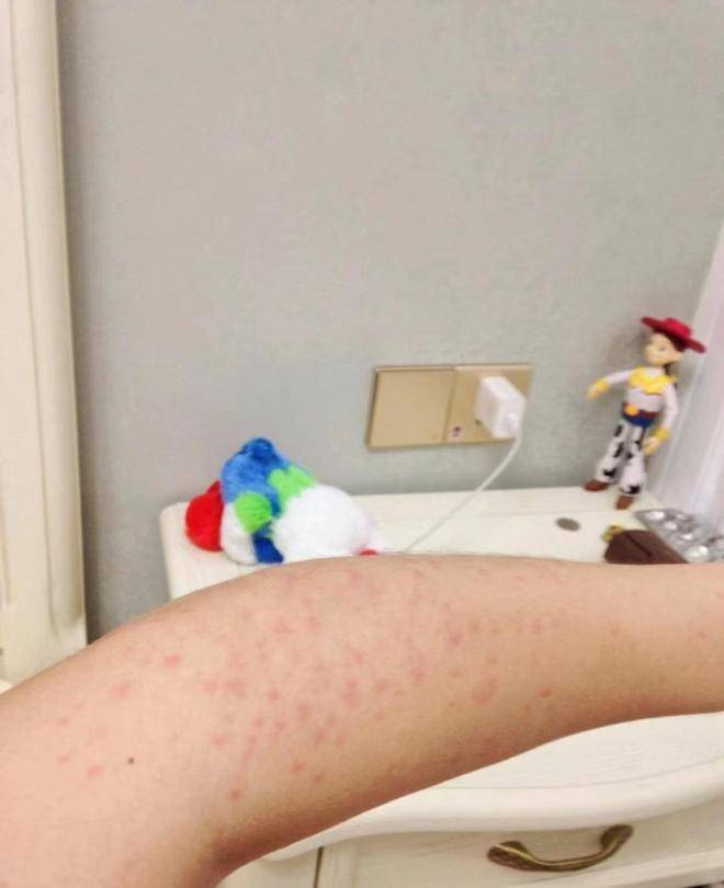 悔才知道这个祛湿疹的方法!_皮肤_办法_时候