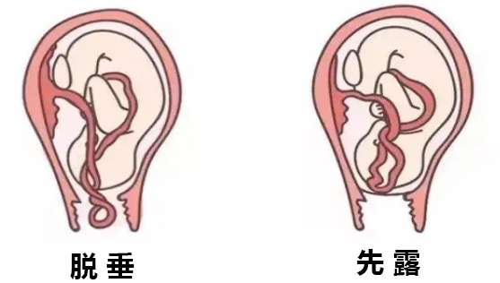 隐性脐带脱垂 又称脐带先露