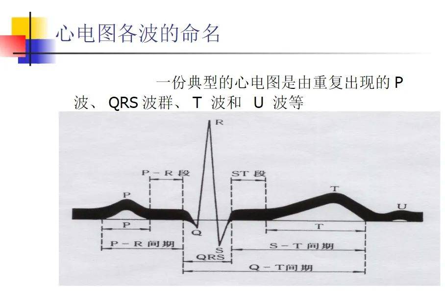 室上性心律心电图特征图片