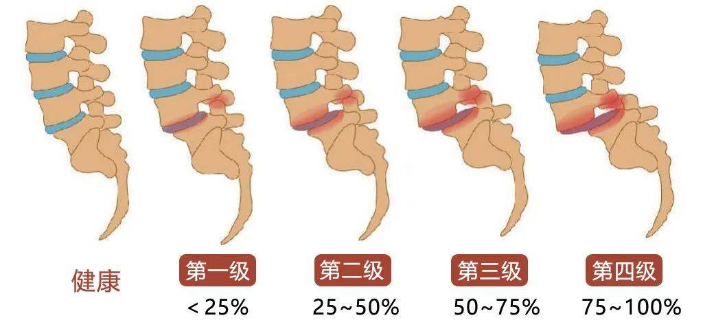 腰椎间盘