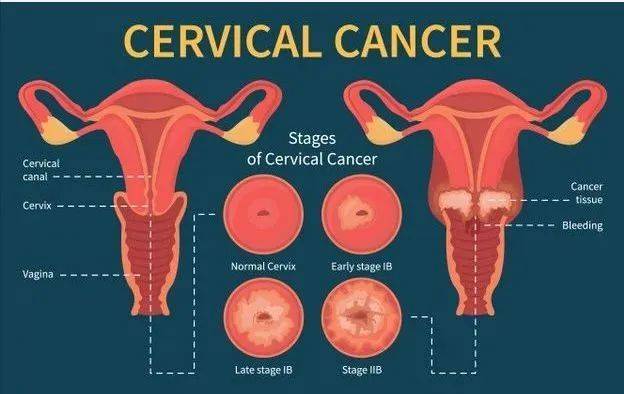 宫颈癌如何分期能活几年?