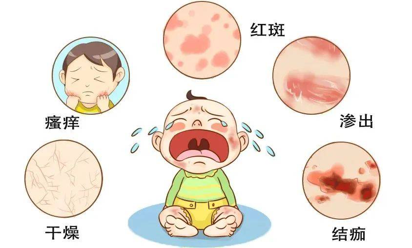 湿疹的病因是什么?可以根治吗?如何预防?会传染吗?