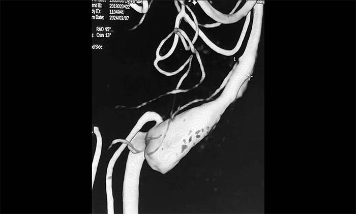 摔倒意外发现多发夹层动脉瘤 席刚明教授团队化险为夷_治疗_血流_导向