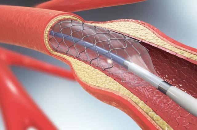 原创国内将逐渐停止心脏支架手术做完人就废了医生说出大实话