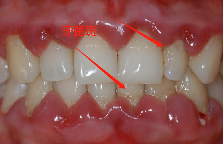 牙周炎图片牙齿图片