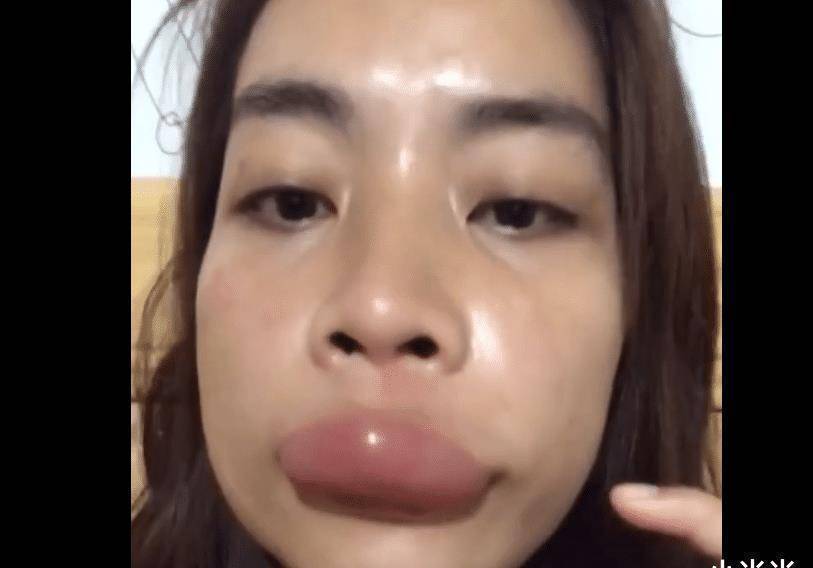 家的时候,嘴巴变成了这个样子,也太可怕了,她的嘴巴被蜜蜂蛰成了这样