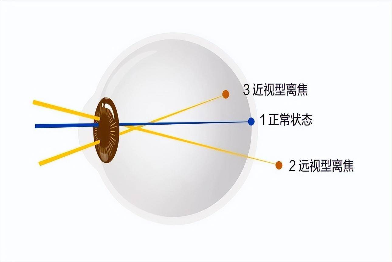 离焦眼镜为什么能延缓近视的发展这里告诉你答案