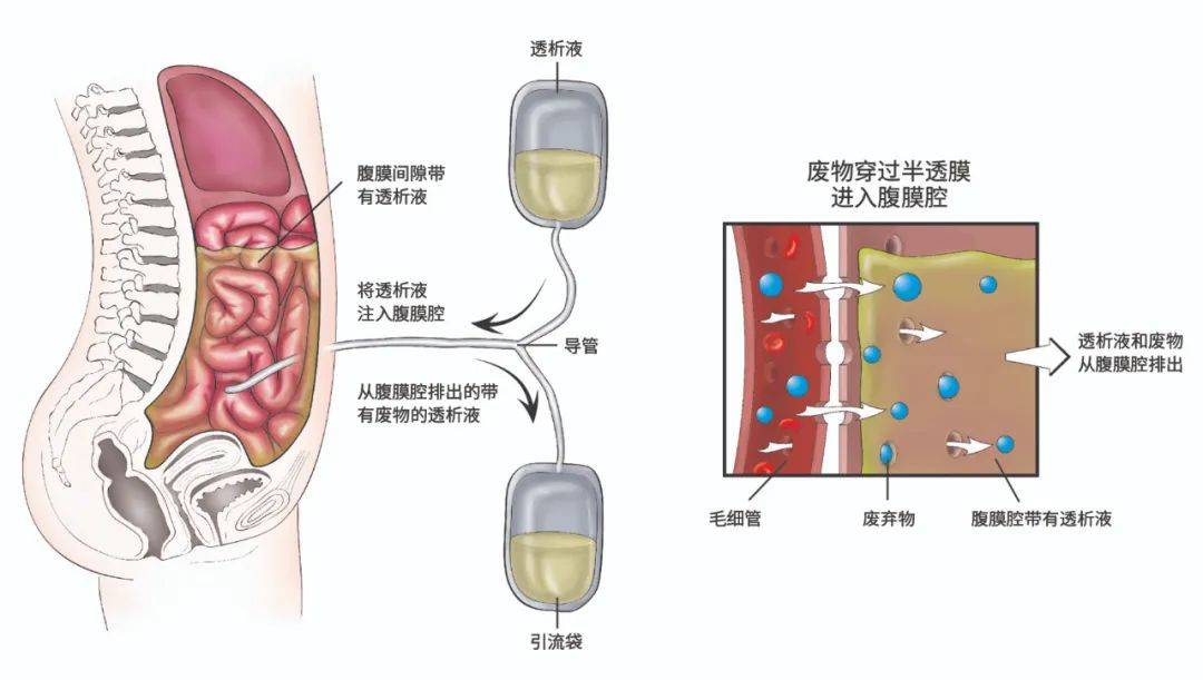 腹膜透析插管腹部的图图片