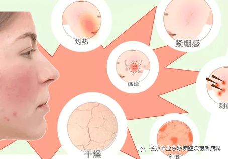 反复长痘你以为是痘痘肌其实你是激素脸