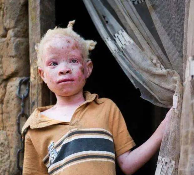 非洲"唐僧肉",血液比黄金还贵,警察只能24小时守护他们_黑人_病人