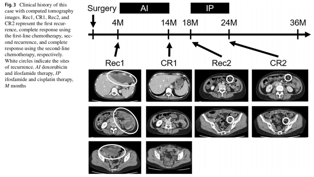 第一次手术四个月后,ct扫描发现了几处腹膜播散提示复发(图3,rec1).