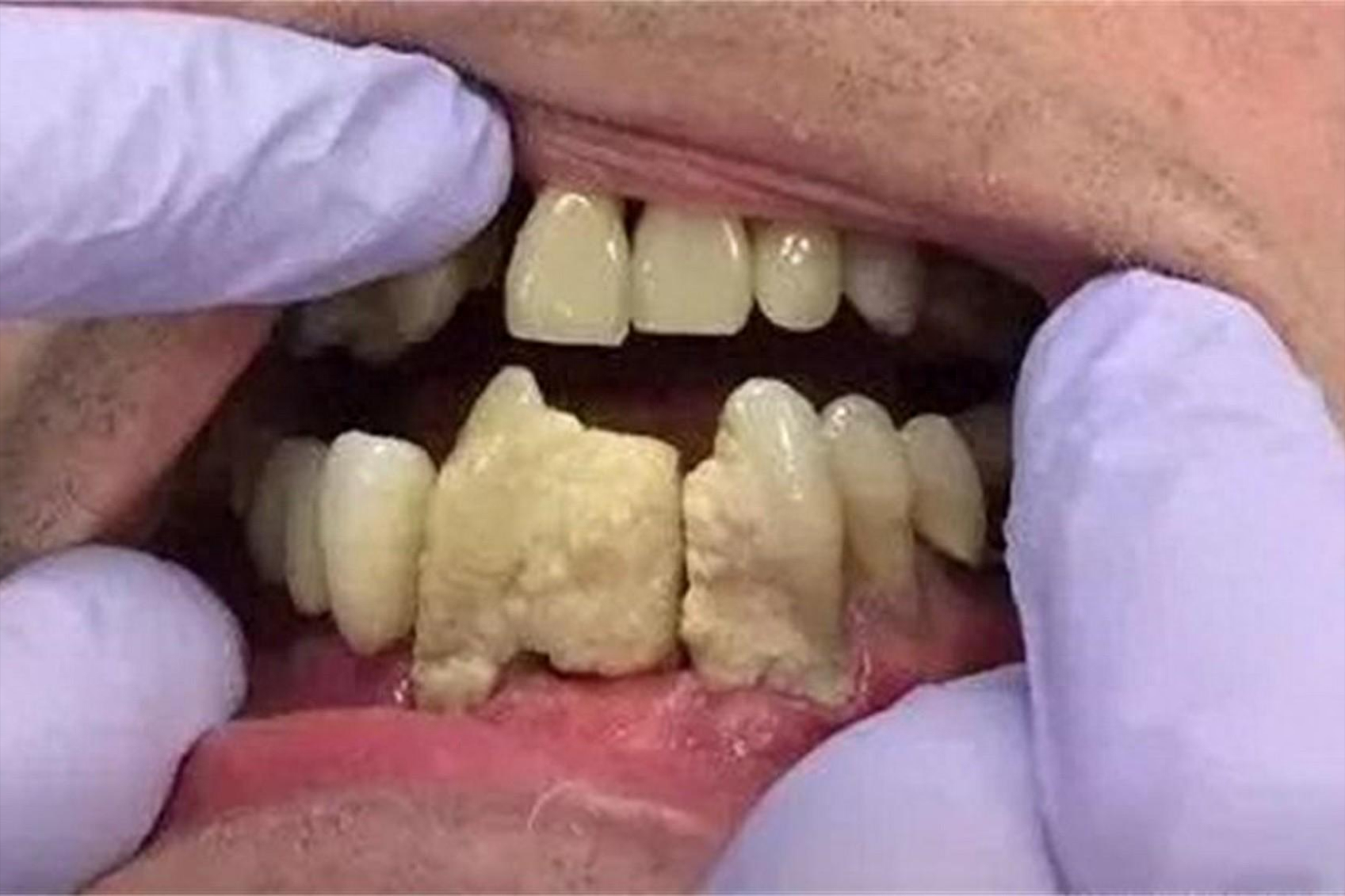 牙结石别再用手抠掌握3个洁牙方法牙石分分钟掉光