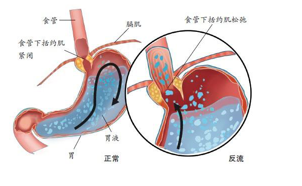 贵阳东大肛肠医院饭后葛优躺反酸烧心小心胃食管反流病