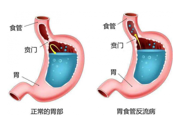 小心胃食管反流病