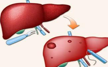 乙肝转肝癌的4个持续症状,有这些,要去医院了_进行_治疗_肝脏