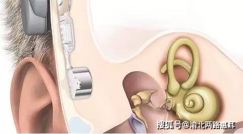 重庆渝北小耳畸形选配骨导助听器显效惠耳听力验配案例